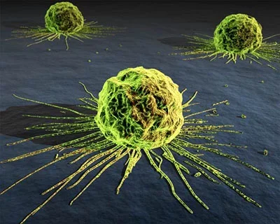 Cáncer, esa palabra tan temida
