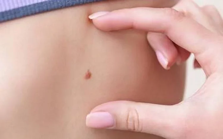 Cuidar nuestra piel durante todo el año, una acción indispensable para prevenir el cáncer de piel